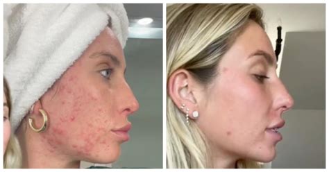 alix earle before accutane|Dermatologist Reacts to Accutane Journey from Alix Earle